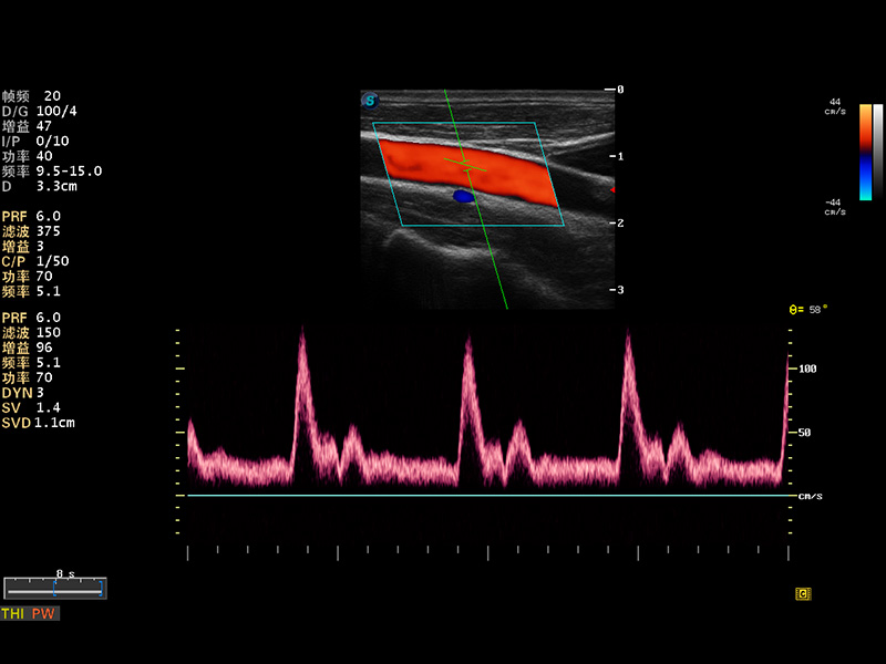 頸動(dòng)脈PW